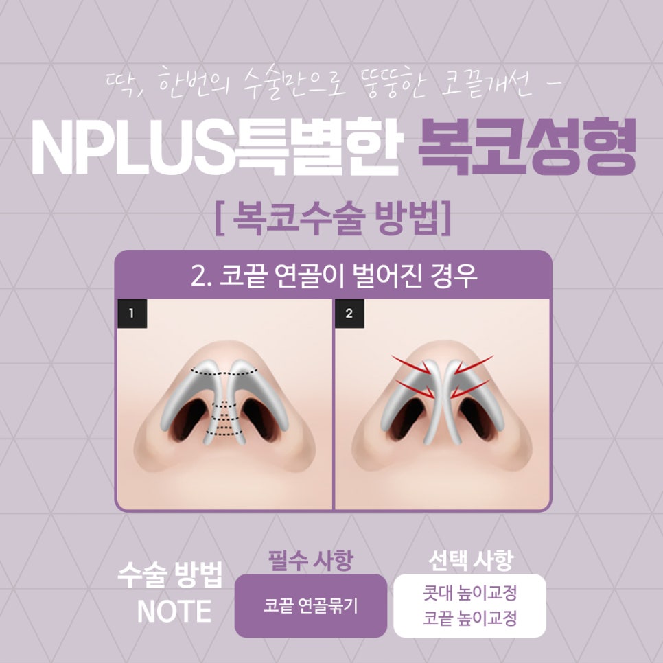 복코수술후기 슬림한 라인으로 관련 이미지 8
