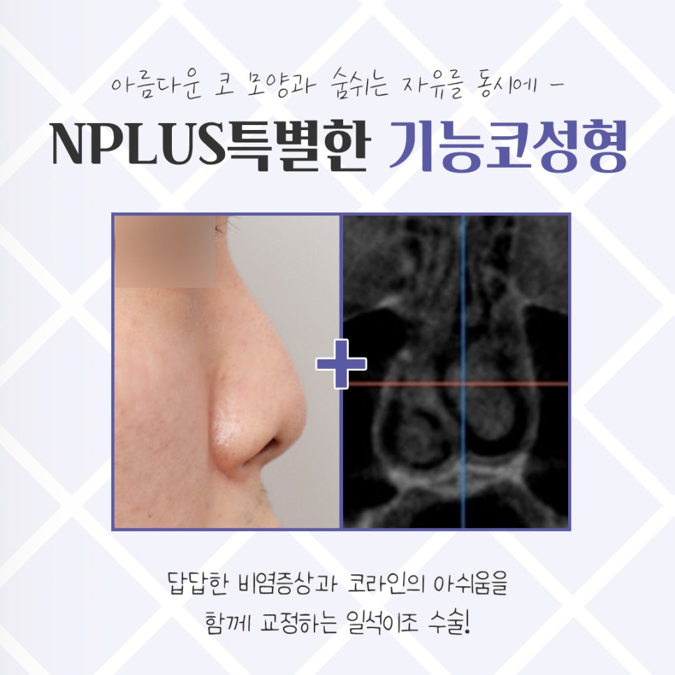 기능코수술후기 잘 알아보고 선택 관련 이미지 3