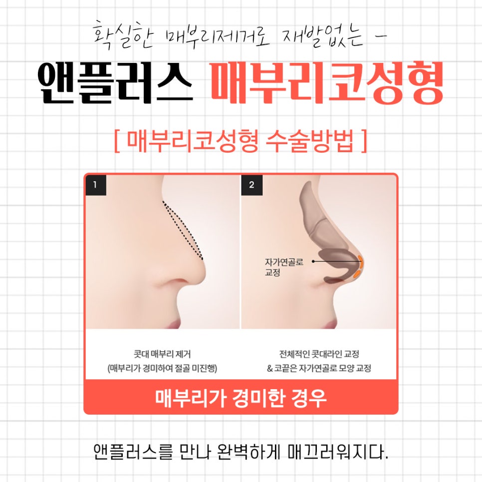 A Complete Guide to the Causes of a Hump Nose and Surgical Methods image 9