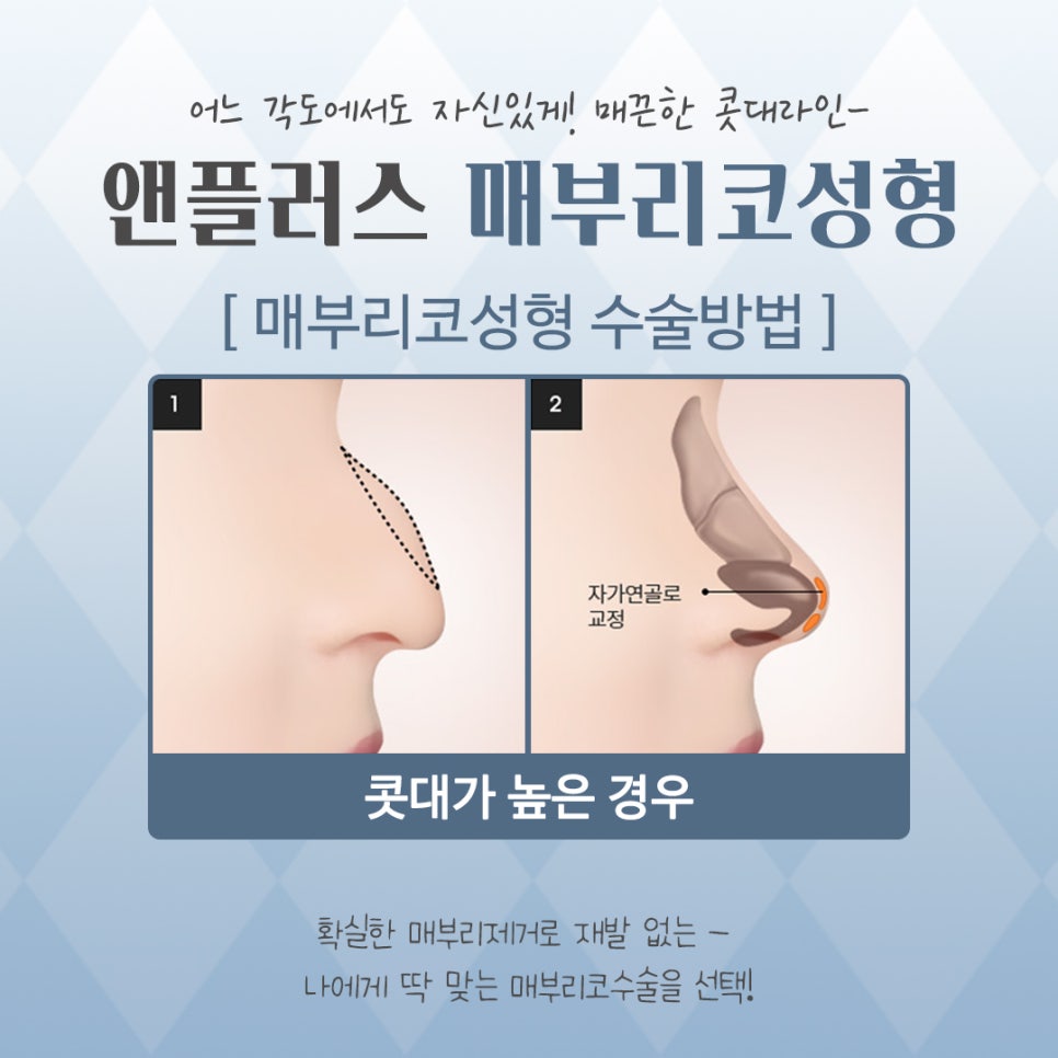 Looking into Cases of Before and After Hump Nose Surgery image 8