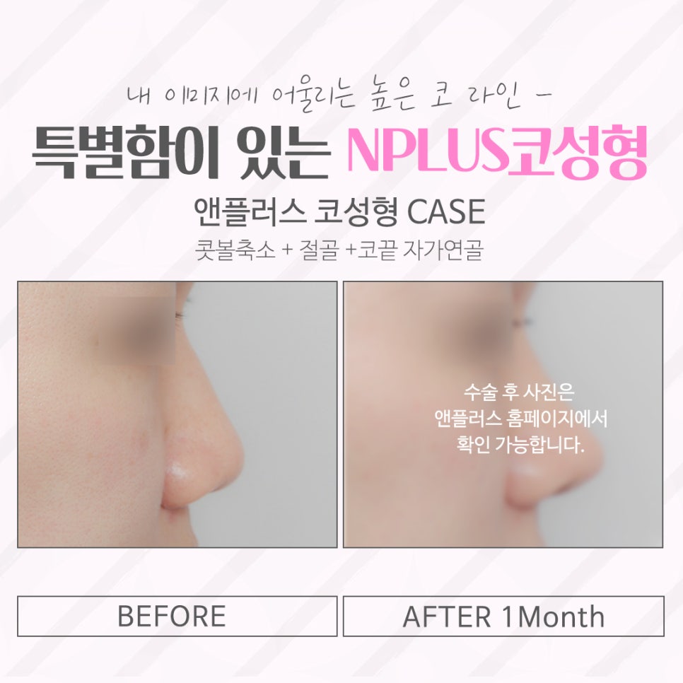 압구정코수술 자연스러운 라인으로 관련 이미지 14
