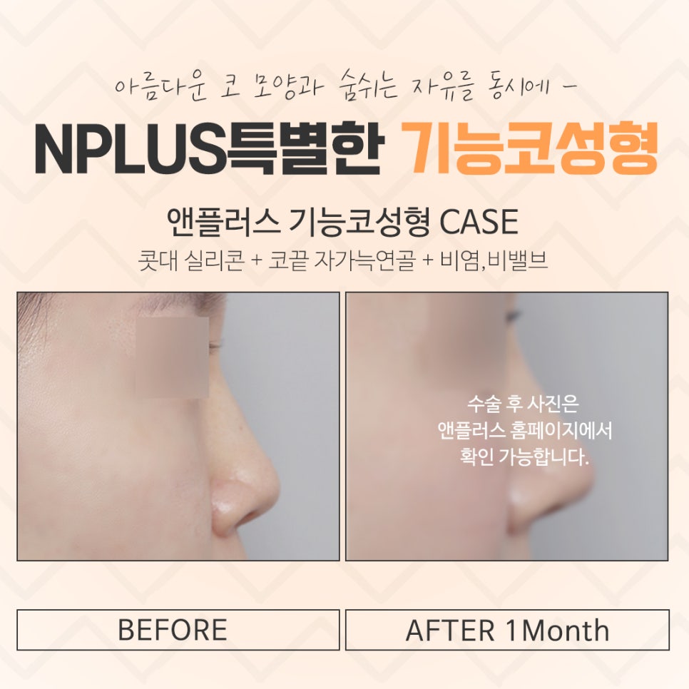 기능코수술후기 자세하게 알아봐야 관련 이미지 14