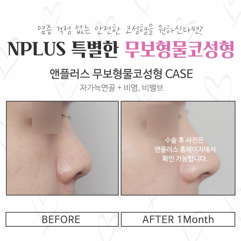 Checking Whether Non-Implant Nose Surgery Is Possible image 13