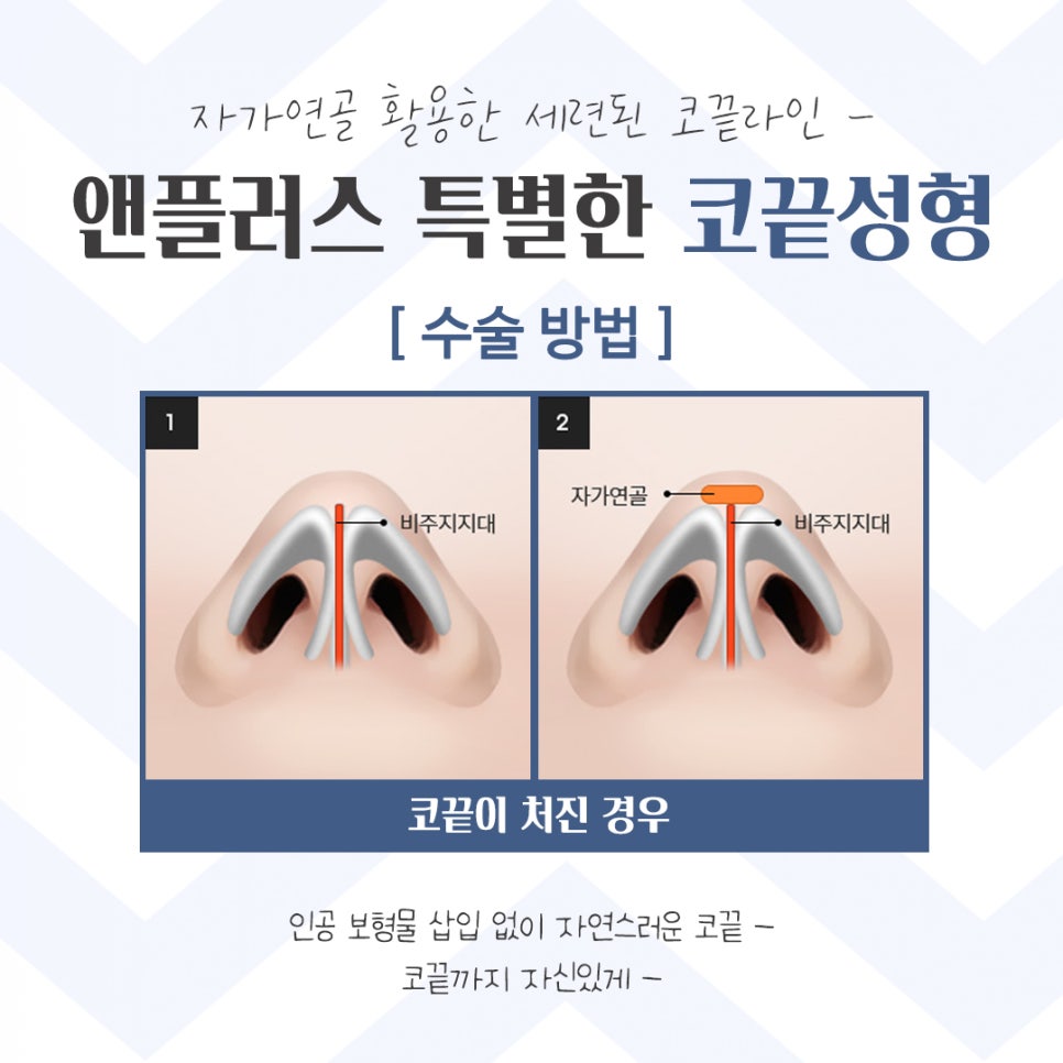 코끝성형 후기까지 확인하고 관련 이미지 10