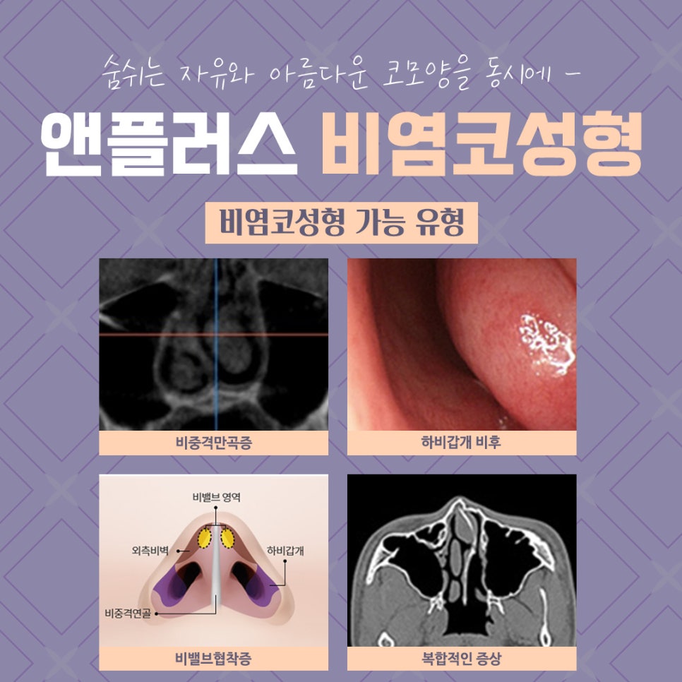 Looking Into Rhinitis Rhinoplasty Reviews and Benefits image 6