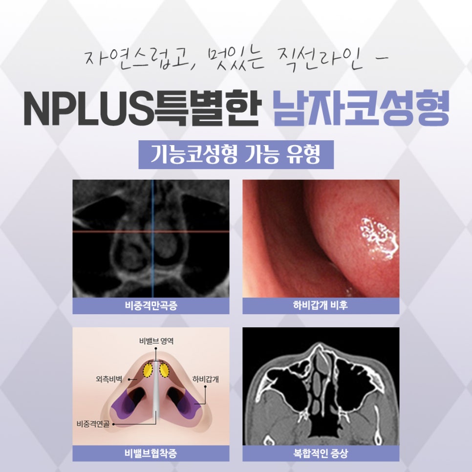 Looking Closely at Before-and-After Male Nose Surgery image 10
