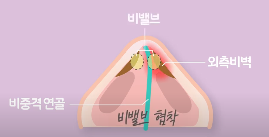 기능코성형 실비 어떤 경우에 받을 수 있는지? 관련 이미지 9