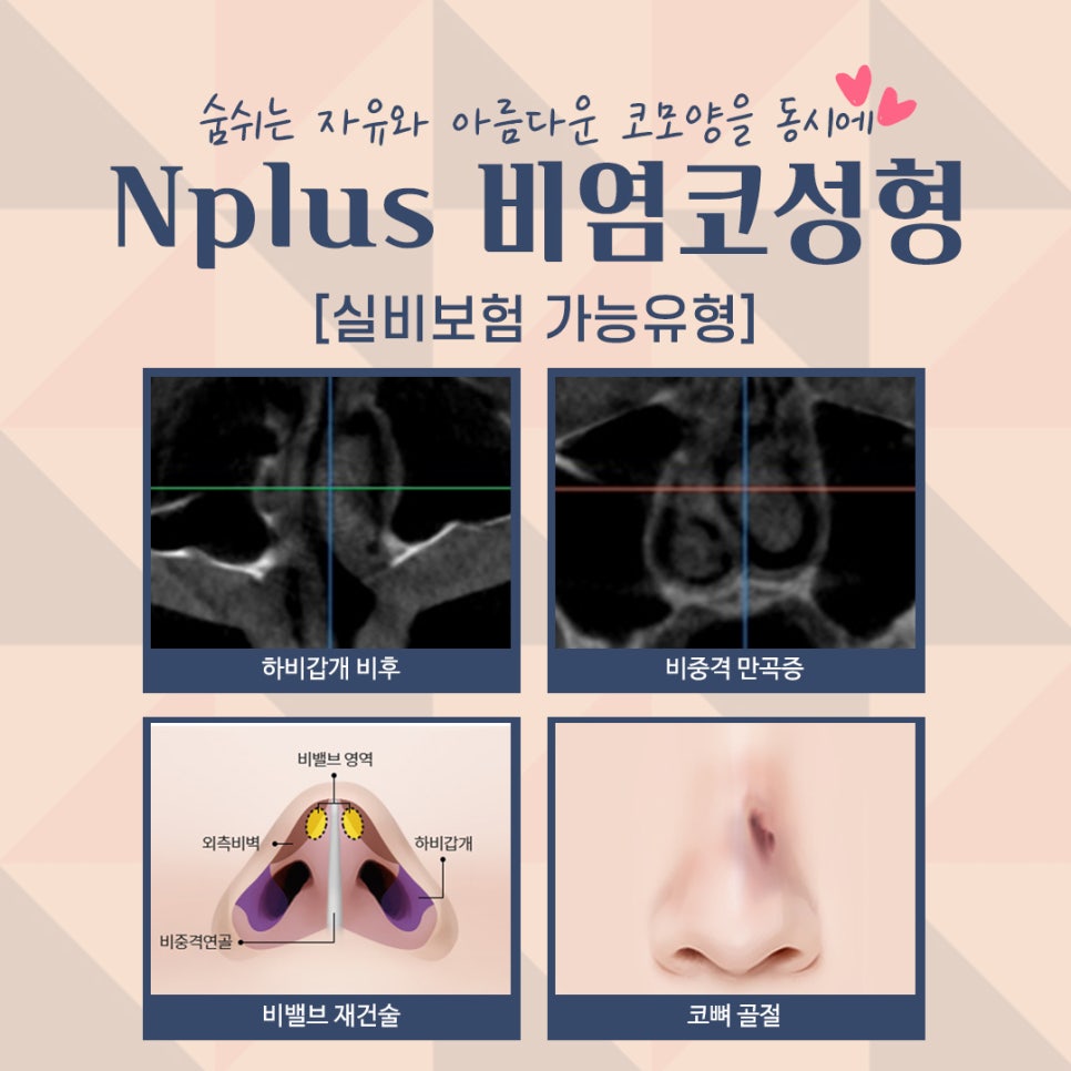 비염수술 정확한 진단으로 관련 이미지 9