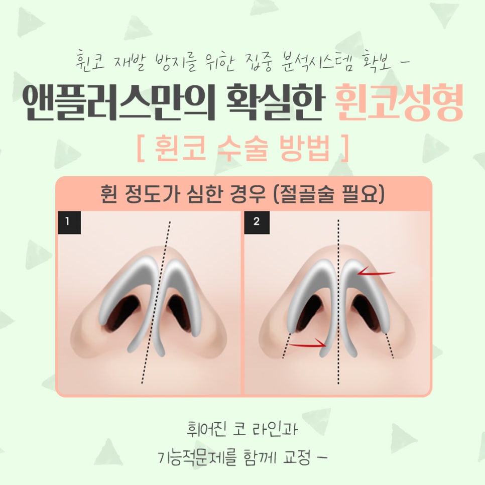 휜코성형후기 자세하게 알아보고 관련 이미지 10