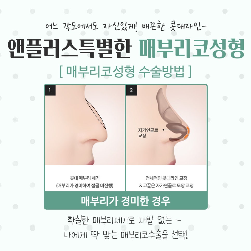 매부리코성형후기 코끝처짐을 개선하여 관련 이미지 11