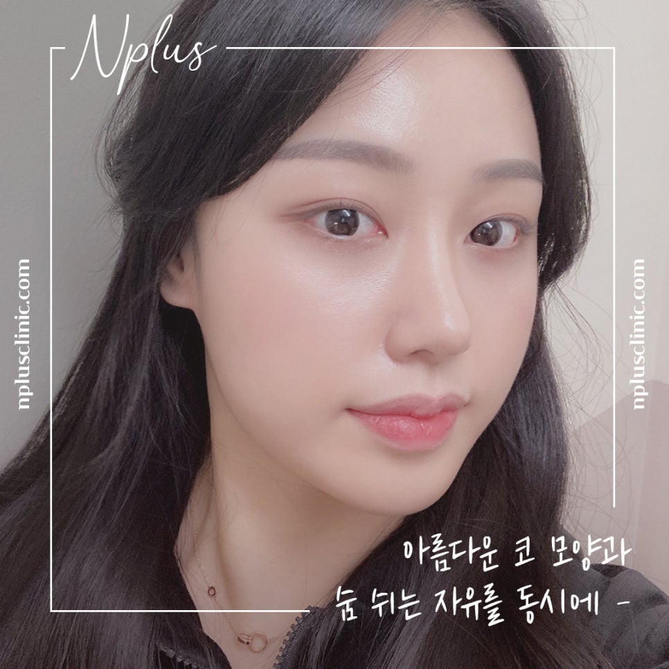 늑연골코수술을 통해 세련된 라인으로 관련 이미지 12