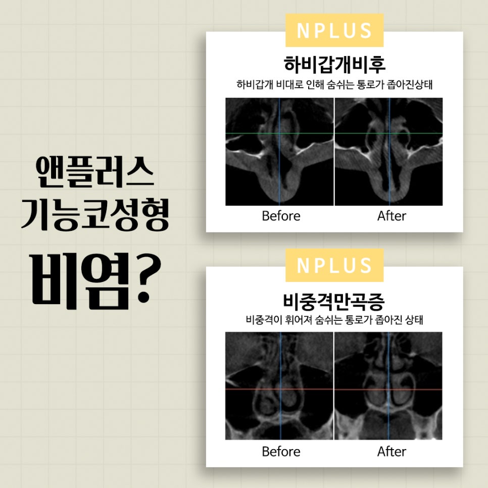 Learn More About Functional Rhinoplasty Insurance Coverage image 4
