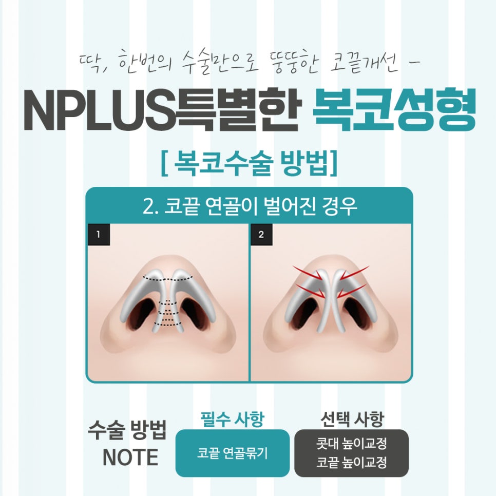 복코수술전후 확실한 차이를 알아보고 관련 이미지 8