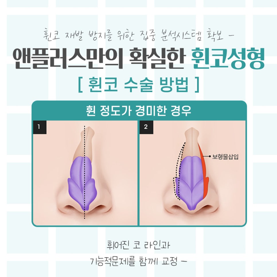 Understanding the Issues in Crooked Nose Surgery Accurately image 7