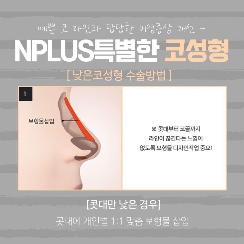 The Importance of Choosing Low Nose Augmentation Reviews image 9