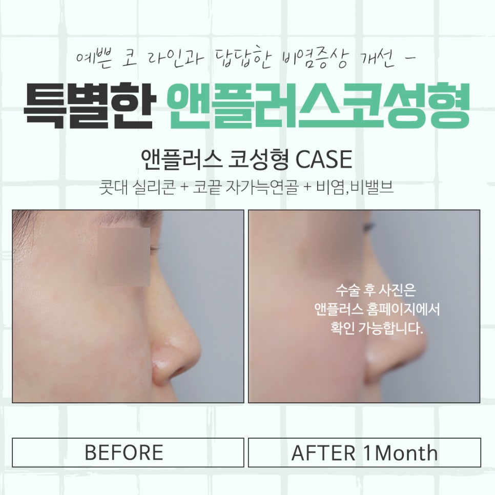 Learn in Detail About Nose Surgery in Gangnam image 13