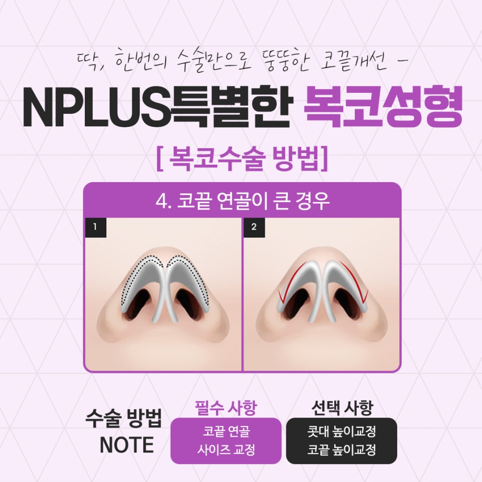 복코수술후기에 대해 세세하게 알아보고 관련 이미지 11