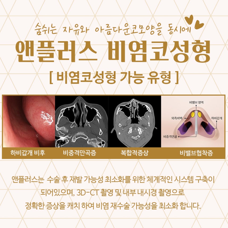 비염코성형후기 예쁜코라인을 생각하면서 관련 이미지 6