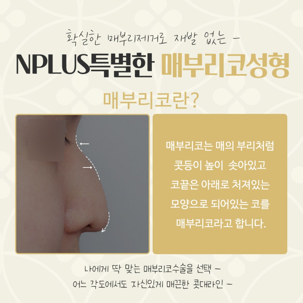 매부리코수술후기 확인하고 부드러운 인상으로 관련 이미지 4