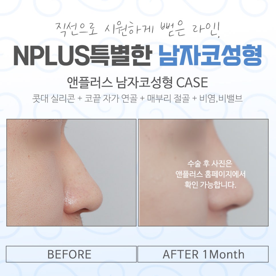 남자코성형전후 비교해 보고 관련 이미지 13