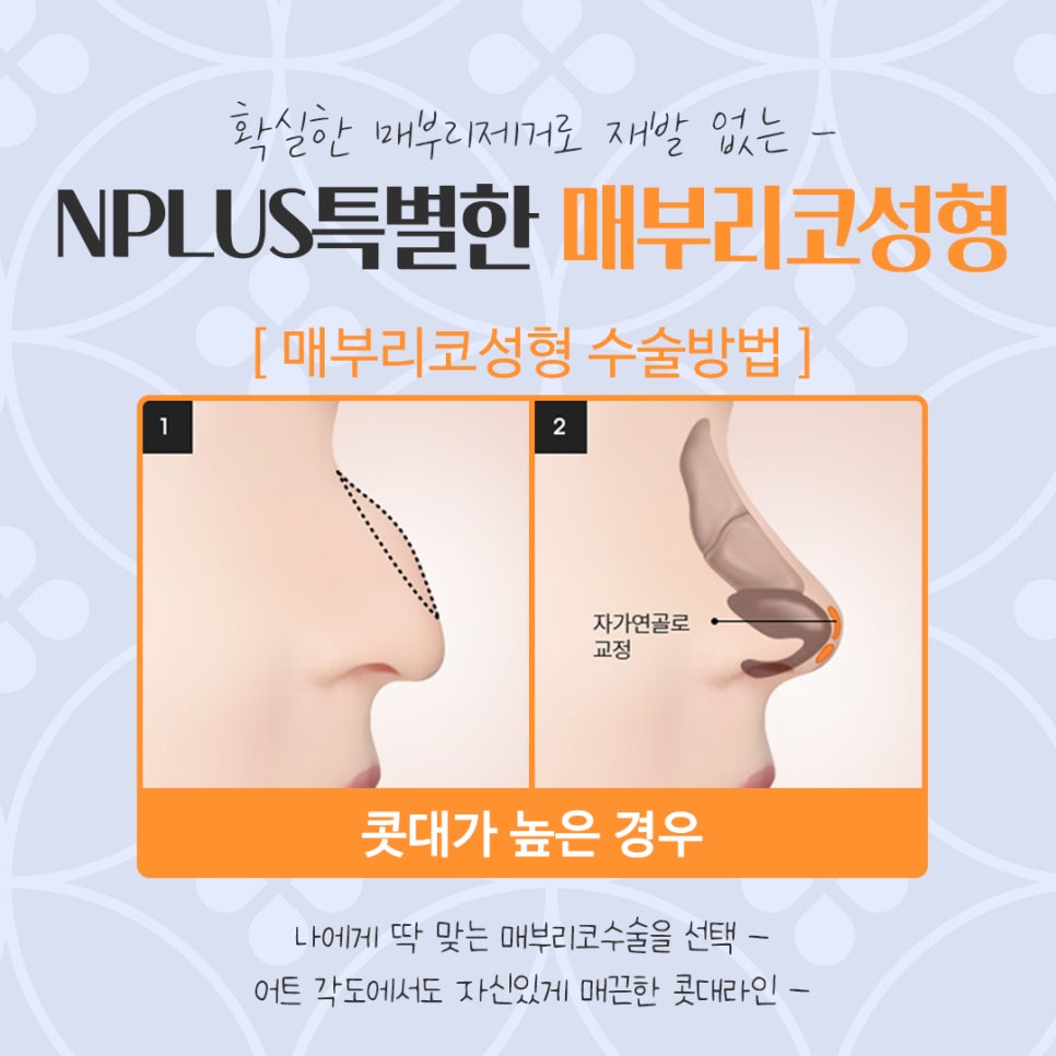 매부리코성형후기 매부리코 잘하는 곳에서 관련 이미지 10