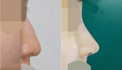 앤플러스 의원 : 코끝이 처진 매부리코 교정 관련 이미지 1