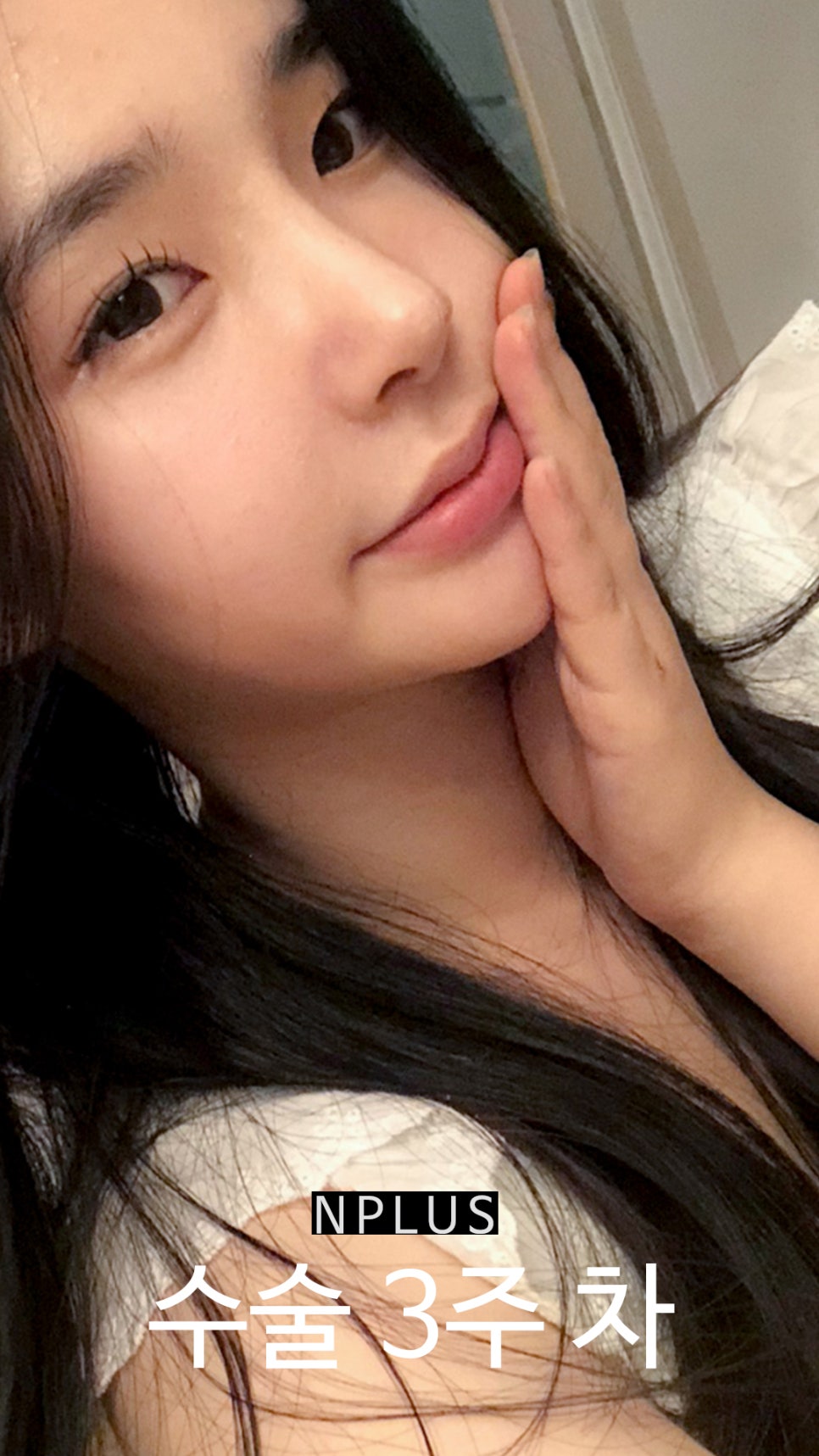 AN Plus Plastic Surgery Review: Silicone Nasal Bridge, Autologous Rib Cartilage Nasal Tip, Under-Eye Fat Repositioning, Fat Grafting image 9