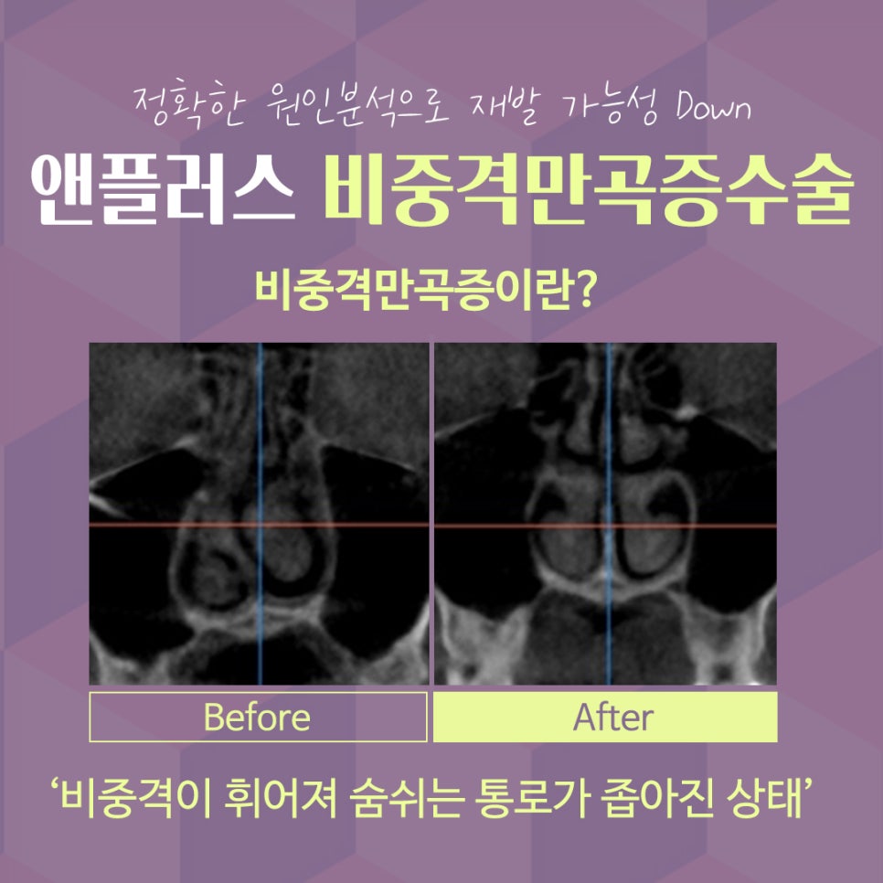 비중격만곡증수술후기 라인까지 고려해서 관련 이미지 4