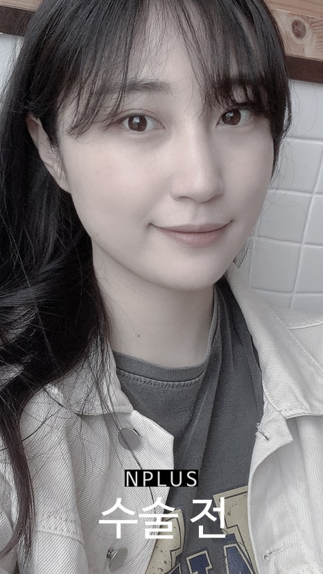 앤플러스에서 진행된 매부리코성형후기 관련 이미지 1