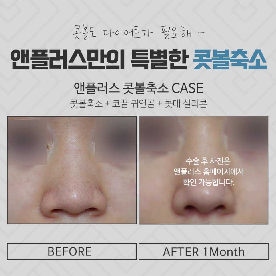 Reviewing Nostril Reduction Results and Improving Your Appearance image 14