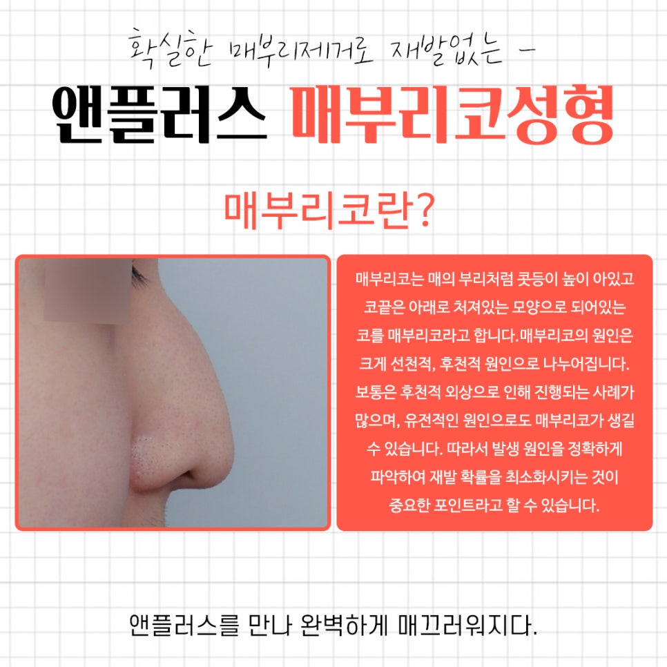 A Complete Guide to the Causes of a Hump Nose and Surgical Methods image 3