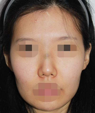 1_여자 매부리코 수술전후 관련 이미지 1