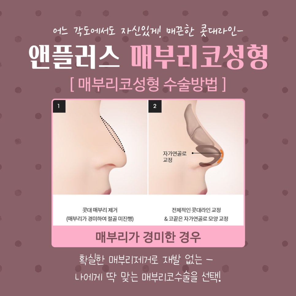 코끝처짐 개선한 매부리코성형후기 관련 이미지 10