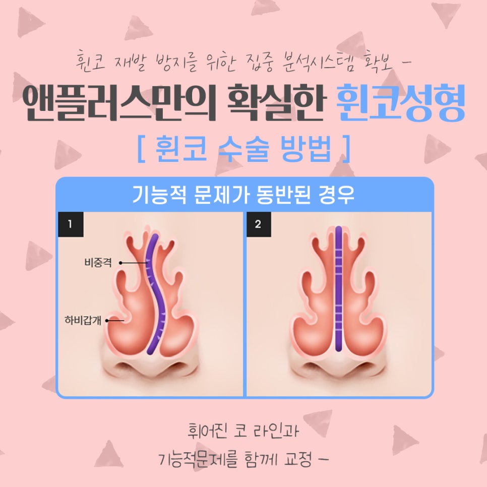 휜코수술후기 꼼꼼하게 알아보고 관련 이미지 10
