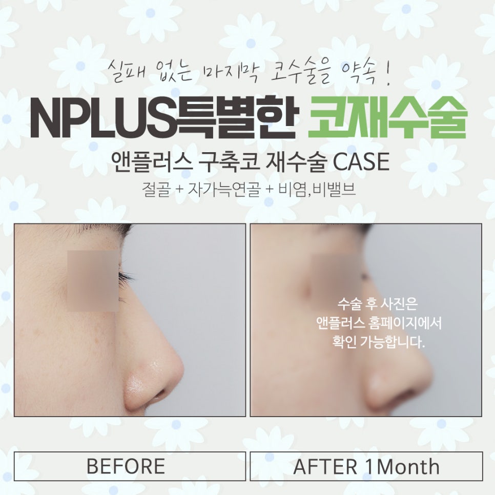 Understanding the Differences in Nose Revision Surgery Reviews image 15