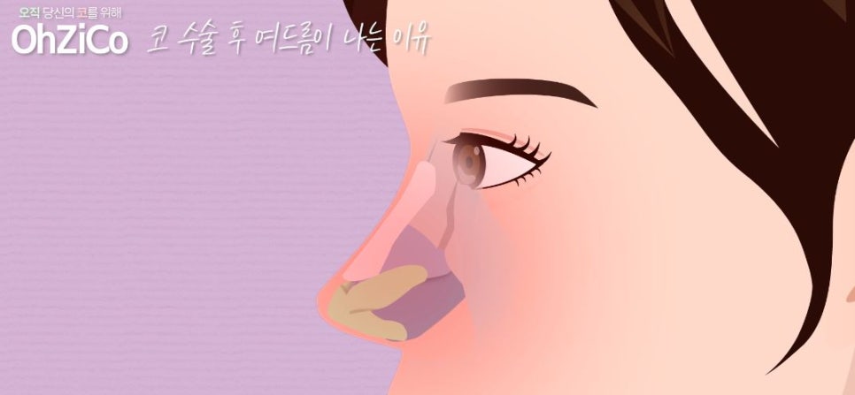코수술후 코여드름 원인과 해결 방법 관련 이미지 5