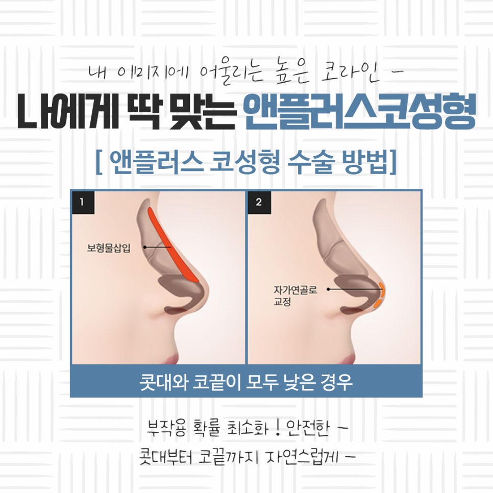 자가연골 이용한 코성형 후기 관련 이미지 8