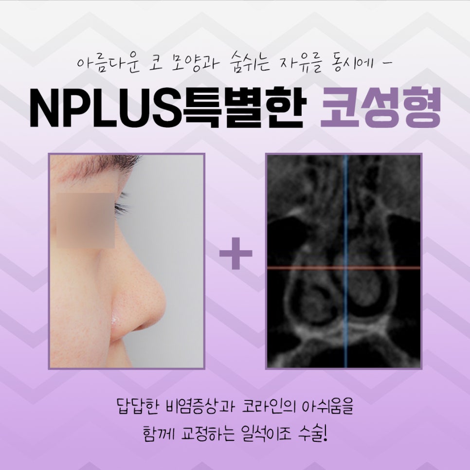 코수술전후 자연스러운 라인으로 관련 이미지 5