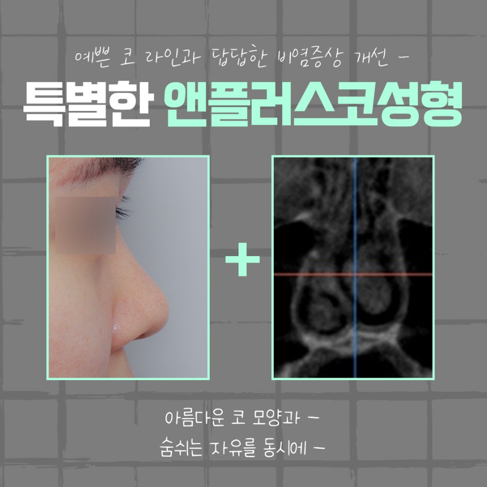 강남코수술후기 확실하게 알아보고 관련 이미지 4