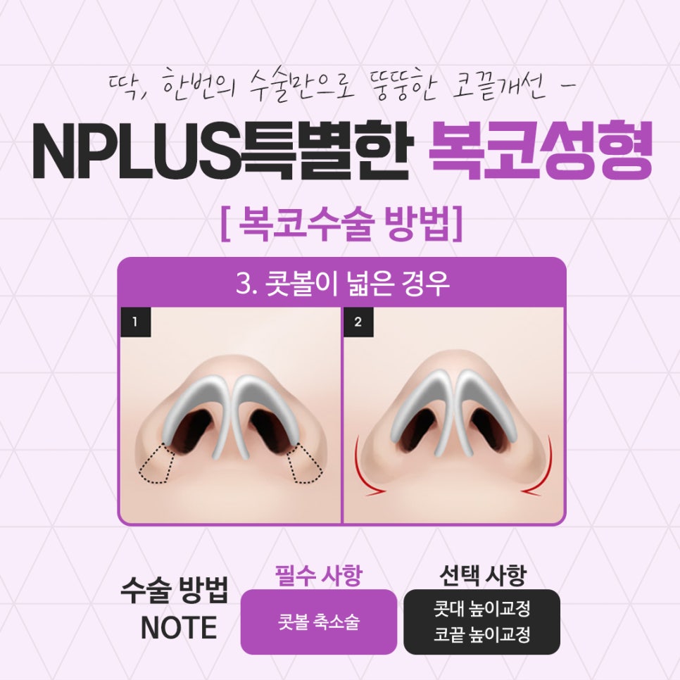 복코수술후기에 대해 세세하게 알아보고 관련 이미지 10