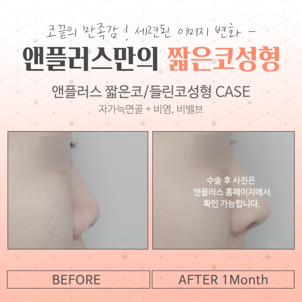 Naturally and Beautifully Through Short Nose Surgery image 16