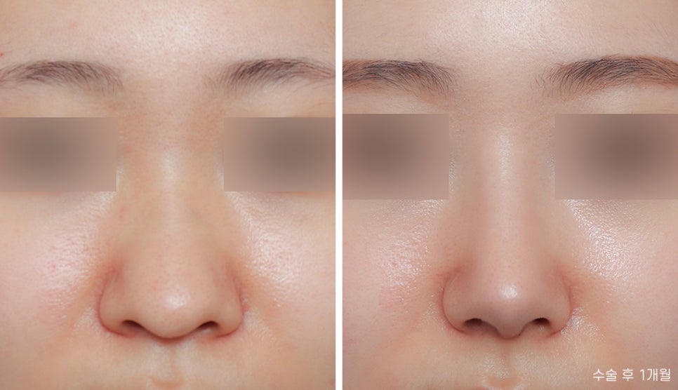 Creating a Straight-But-Slightly-Curved Nose Line with Columella Reduction image 2