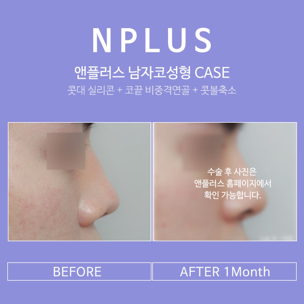 Male Nose Surgery, Considering Function as Well image 9