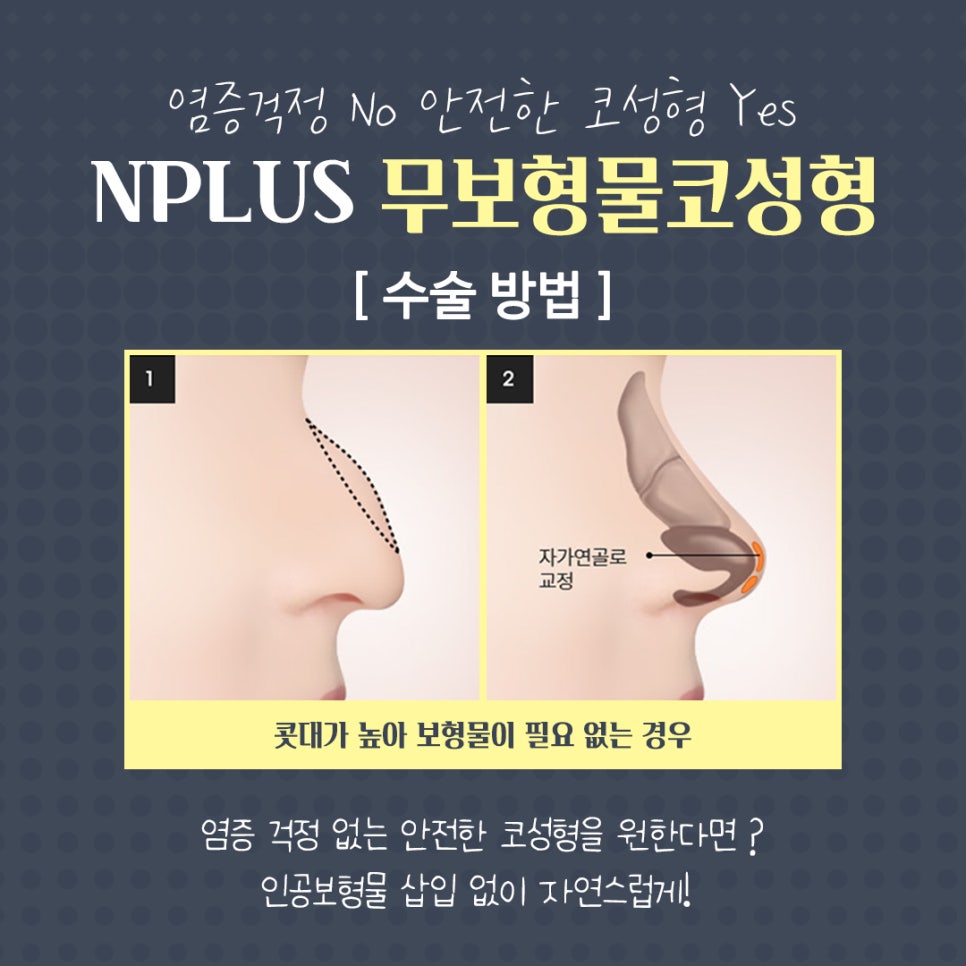 Non-Implant Nose Surgery Using Autologous Cartilage image 9