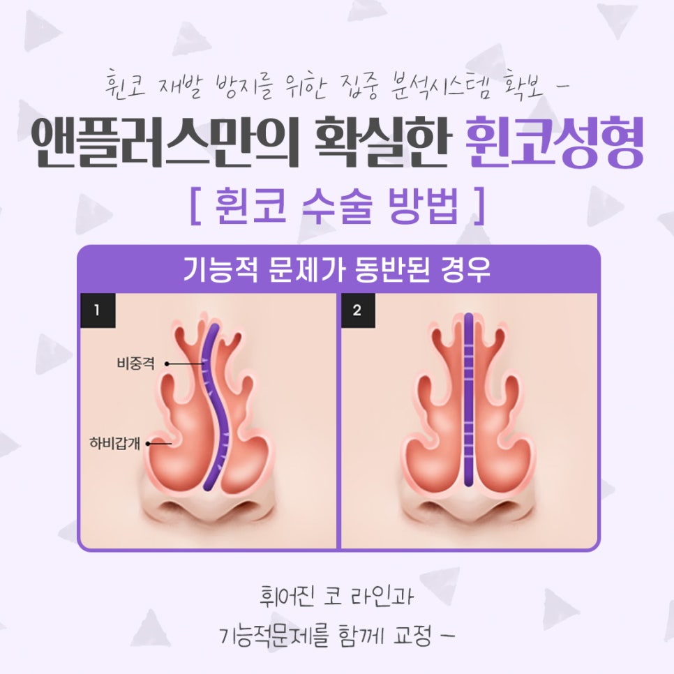 Bent Nose Surgery Review: With an Accurate Diagnosis image 11