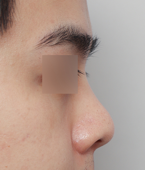 Natural and Satisfying Non-Implant Nose Surgery for Men image 1