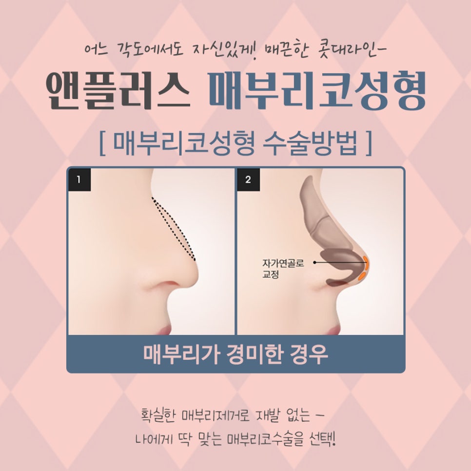 A Smooth Nasal Bridge Line Through Hump Nose Correction image 10