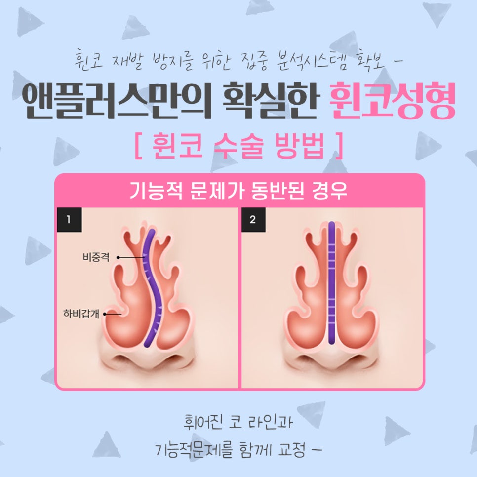 휜코성형 정확한 문제 파악으로 관련 이미지 11