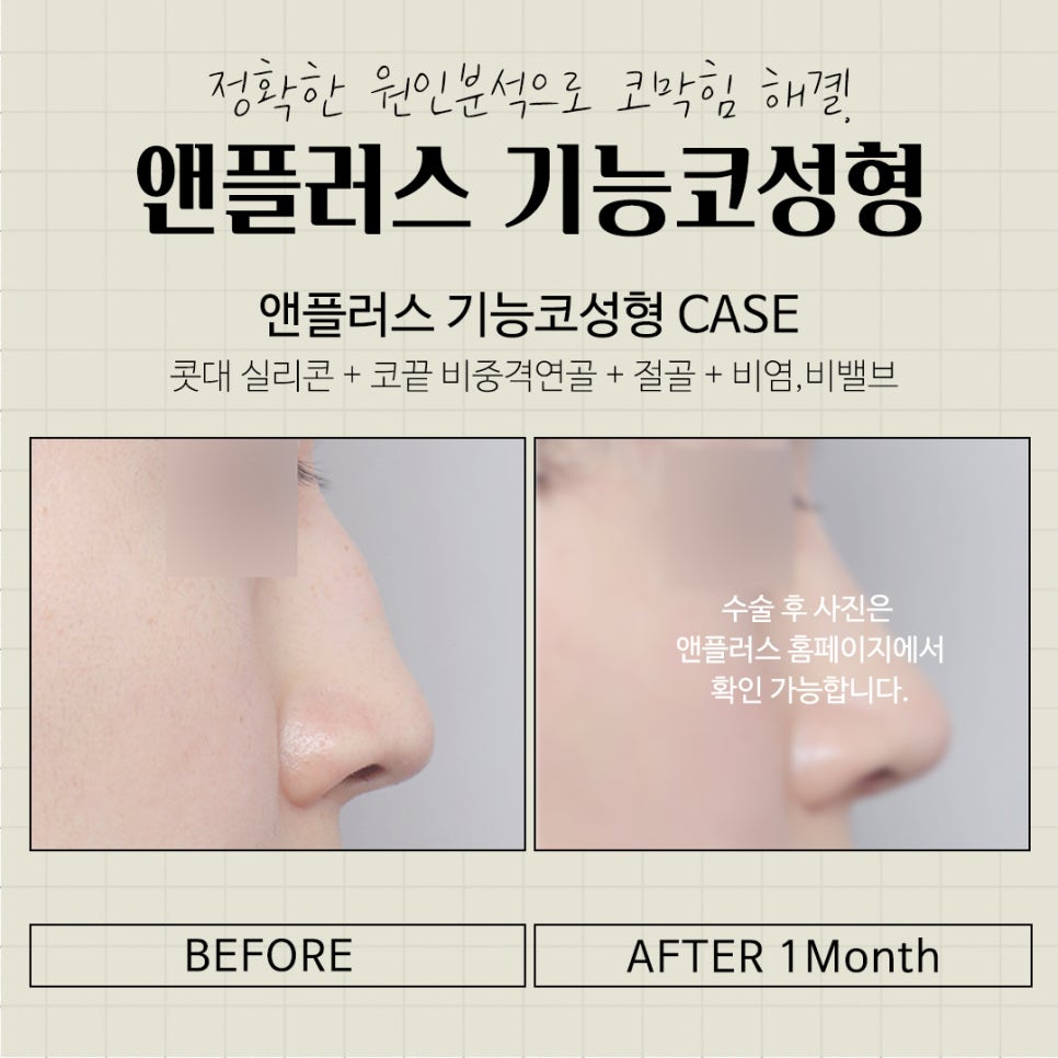 Learn More About Functional Rhinoplasty Insurance Coverage image 12