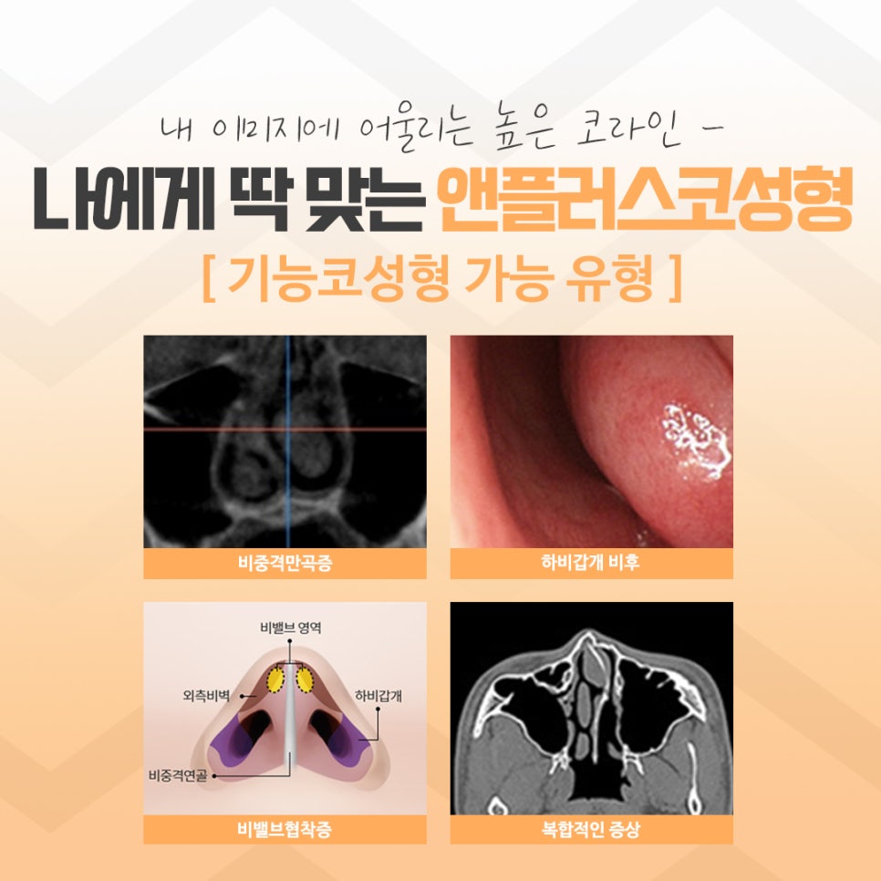 코수술후기에 대해 자세히 찾아보고 관련 이미지 5